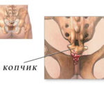 Кокцигодиния